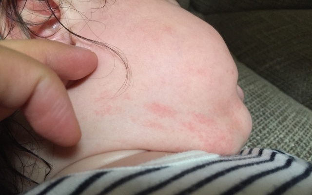 赤ちゃんの湿疹